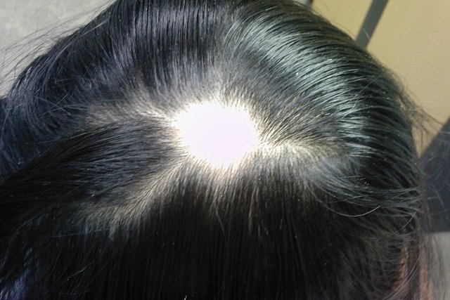Alopecia Areata: Symptoms, Causes & Treatment - Tua Saúde