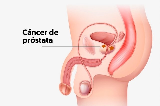 cancer de prostata ubicacion
