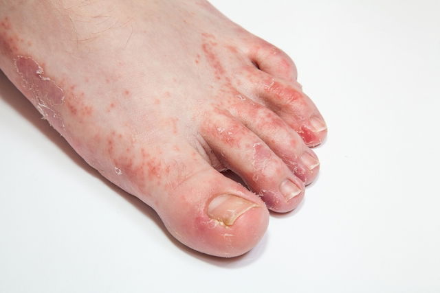 toe-skin-peeling