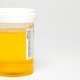 Glicose na urina (glicosúria): o que é, causas e tratamento