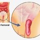 Hérnia femoral: o que é, sintomas, causas e tratamento