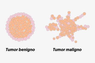 Imagem ilustrativa do artigo Neoplasia: o que é, sintomas e diferença entre maligno ou benigno