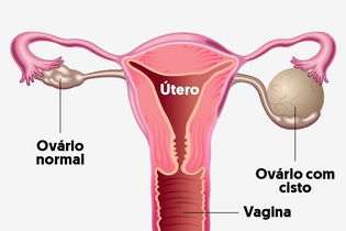 Imagem ilustrativa do artigo 15 sintomas de cisto no ovário