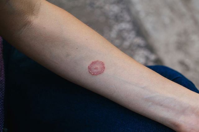 Ringworm: Symptoms, Causes & Treatment - Tua Saúde