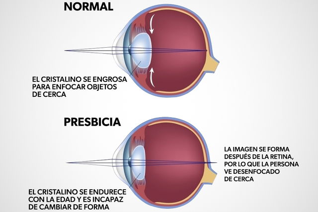 Presbicia Qué Es Síntomas Y Tratamiento Tua Saúde