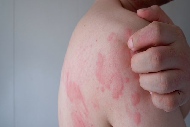 Foto de manchas rojas en la piel ocasionadas por alergia