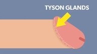 Pearly Penile Papules (Tyson Glands): Causes & Treatment