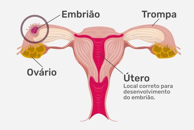 Gravidez ectópica com o embrião se desenvolvendo na trompa