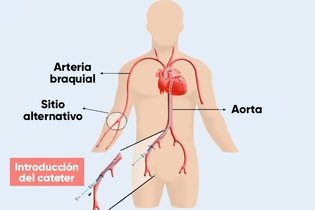 Imagen ilustrativa del artículo Cateterismo cardíaco: qué es, cómo se hace y cuidados