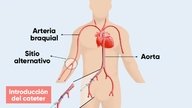 Cateterismo cardíaco: qué es, procedimiento y riesgos