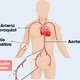 Cateterismo cardíaco: qué es, procedimiento y riesgos