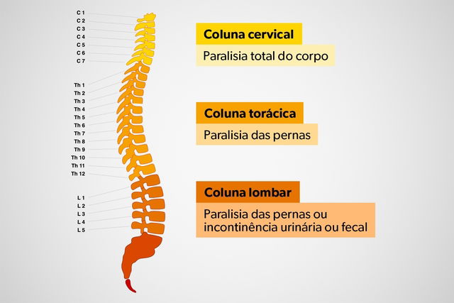 Problemas na coluna vertebral: cuidado com movimentos ao arrumar a