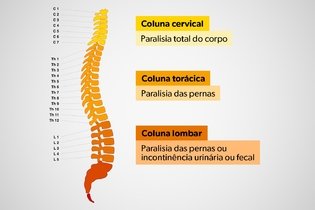Imagem ilustrativa do artigo Fratura na coluna: sintomas, causas, como confirmar e tratamento