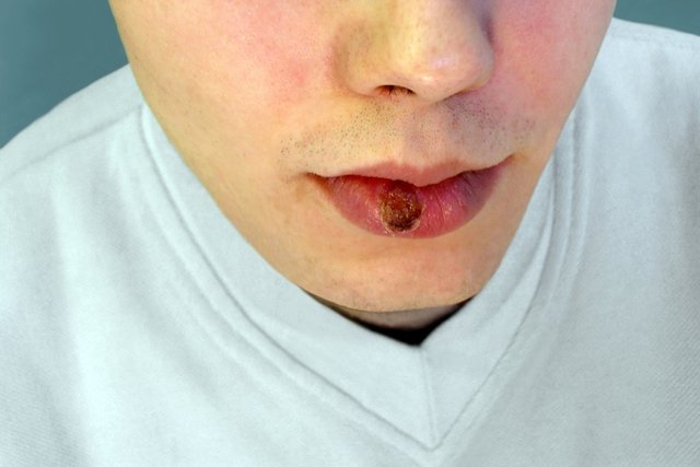 Sífilis primario: chancro en el labio 