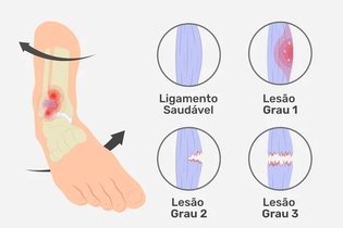 Imagen ilustrativa del artículo Esguince de tobillo: qué es, síntomas, grados y tratamiento 