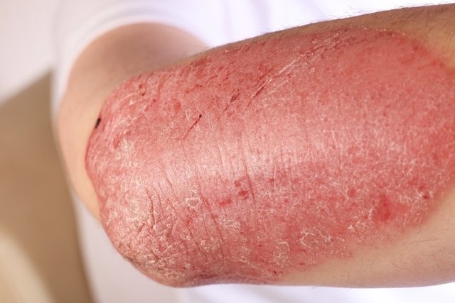 Descamação da pele: 9 principais causas e o que fazer