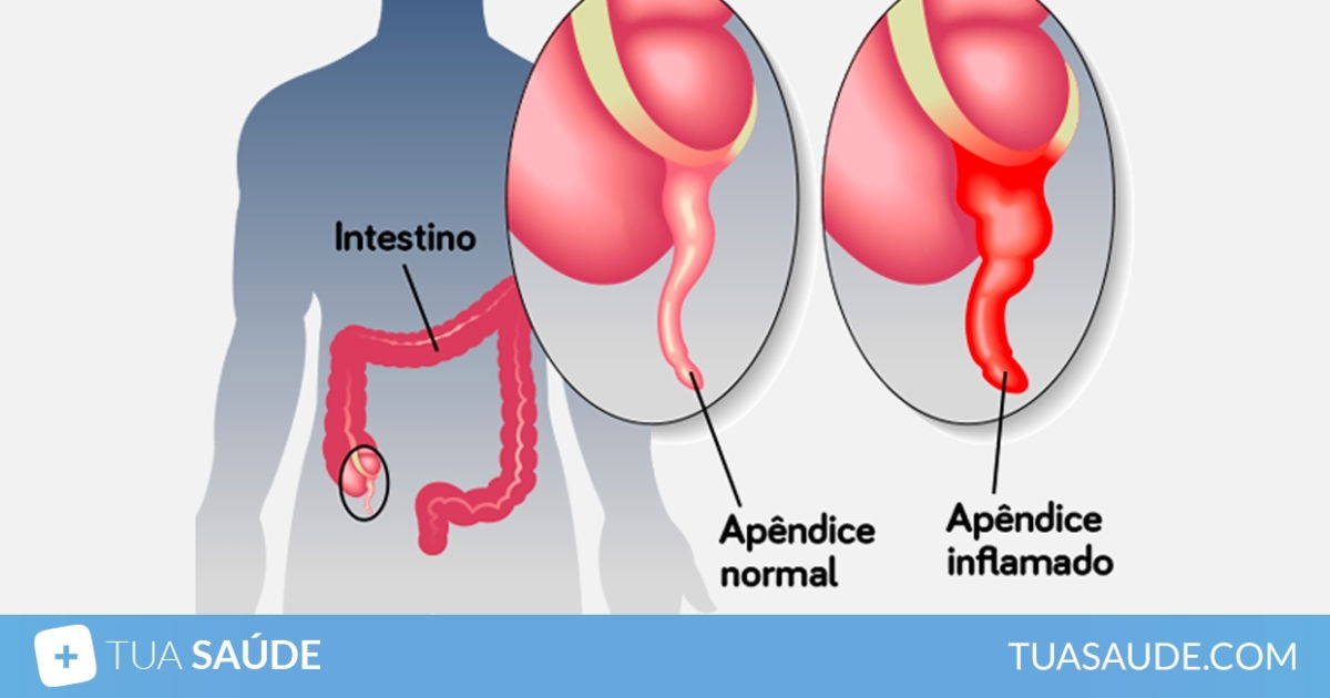 Apendicite O que é Sintomas e Tratamento Tua Saúde
