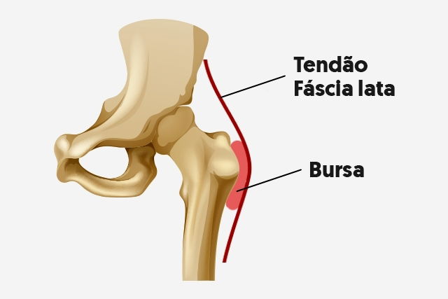 Sintomas de Bursite no Quadril, tratamento e exercícios 