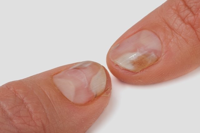 hormigón absorción Automáticamente Enfermedades de las uñas: 11 causas y qué hacer