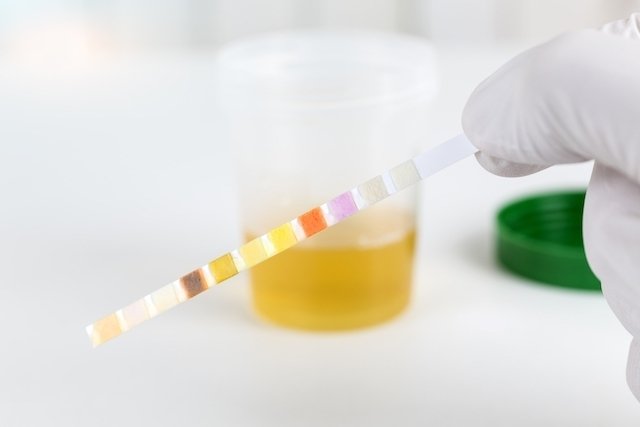 Exame de urina EAS para que serve preparo e resultados Tua Saúde