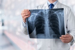 Imagem ilustrativa do artigo Bronquiectasia: o que é, sintomas, causas e tratamento