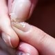 Enfermedades de las uñas: causas y qué hacer