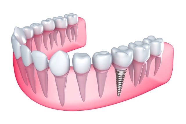 Tipos de prótese dentária e como cuidar