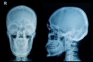 Imagen ilustrativa del artículo Fractura de cráneo: síntomas, tipos y tratamiento