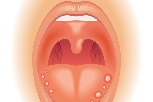 Hpv lingua imagens