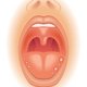 Bolitas en la lengua: 5 causas y qué hacer 