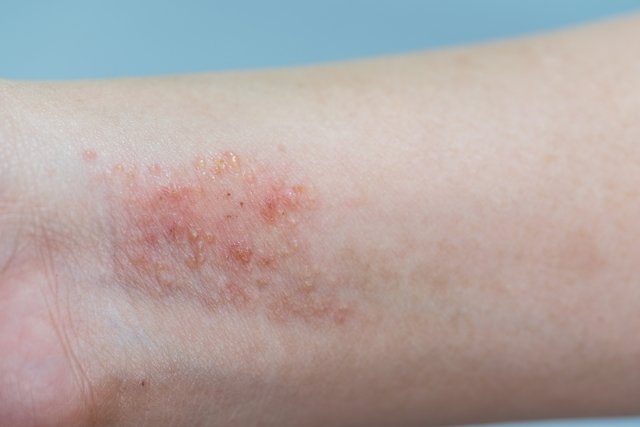 Dermatite de contato - Decât dermatita varicoasa trata - Dermatite de contato Dermatite de contato