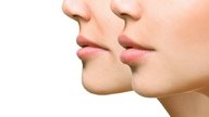 Mononucleose (doença do beijo): o que é, sintomas e tratamento