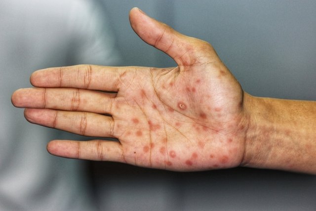Sífilis secundario: manchas rojas o rosadas en las palmas de las manos