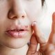 Espinha na boca: 5 principais causas (e o que fazer)