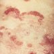 Micose Fungoide: o que é, sintomas e como é feito o tratamento