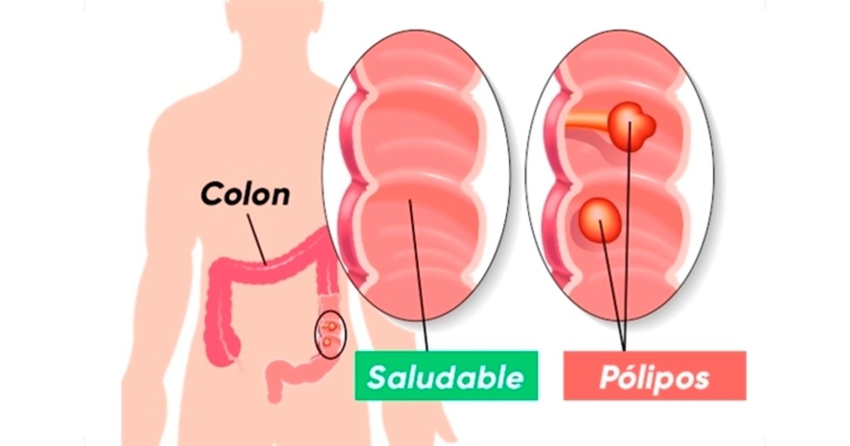cancer de colon primeros sintomas)
