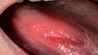 Dolor de lengua: 9 causas y qué hacer