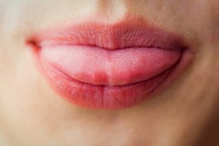Imagem ilustrativa do artigo Herpes na língua: o que é e como tratar