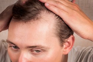 Imagem ilustrativa do artigo Tipos de alopecia: sintomas, causas e como tratar