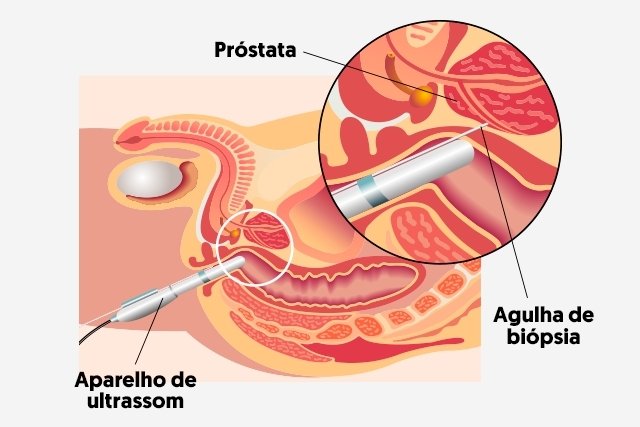 tipos de biópsia da próstata