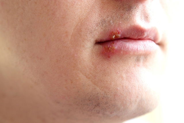 Herpes Labial Sintomas Contágio Causas E Tratamento Tua Saúde