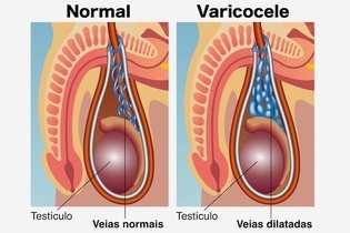 Varicocele: o que é, sintomas, causas e tratamento