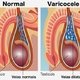 Varicocele: o que é, sintomas, causas e tratamento