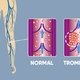 O que é uma trombose, principais sintomas e tratamento