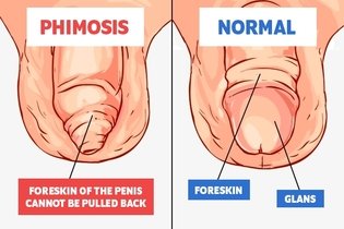 Illustrative image of the article Phimosis: What Is It, Diagnosis & Treatment