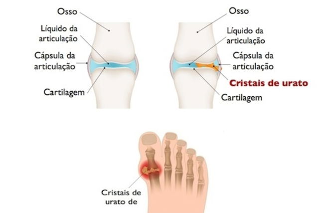 Acúmulo de cristais de urato na articulação