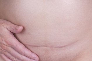 Hérnia incisional: o que é, sintomas, causas e tratamento