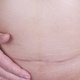 Hérnia incisional: o que é, sintomas, causas e tratamento