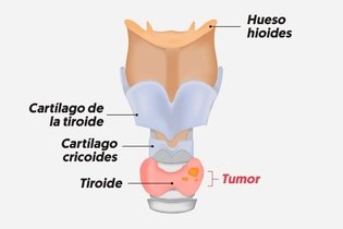 Imagen ilustrativa del artículo Tiroidectomía: cómo se realiza, principales tipos y complicaciones