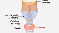Tiroidectomía: cómo se realiza, principales tipos y complicaciones